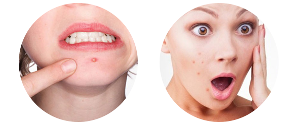 Dầu jojoba điều trị mụn Dầu jojoba điều trị mụn